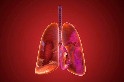 Feinstaub und Lungenkrebs: Die Illustration einer Lunge, gefüllt mit Luft. Heute weiß man: Manche Feinstaubpartikel schaffen es bis tief in die Atemwege – und lösen dort Krankheiten aus.
