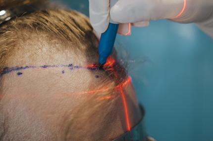 Haartransplantation in Istanbul: Turkish Hairlines