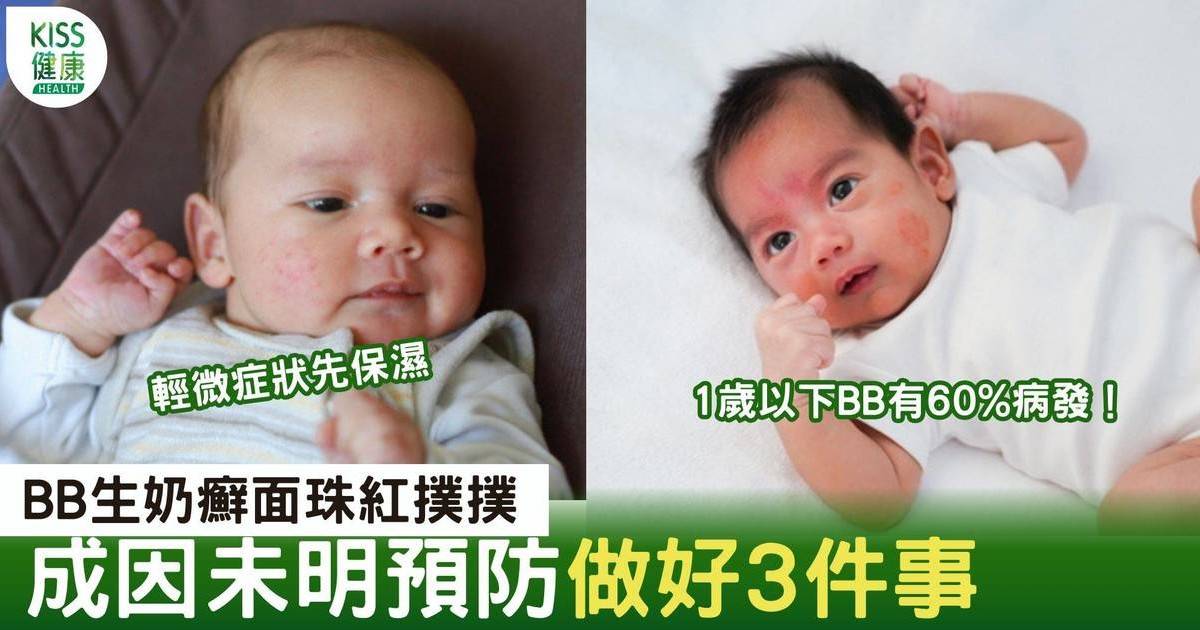 BB奶癬｜ 新手媽媽如何處理？ 即看急救及預防方法