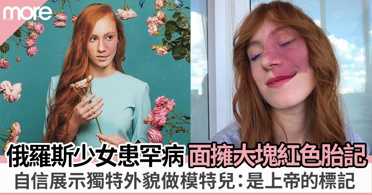 俄羅斯少女患罕病擁大塊紅色胎記 從不自卑做模特兒：不要害怕展示自己