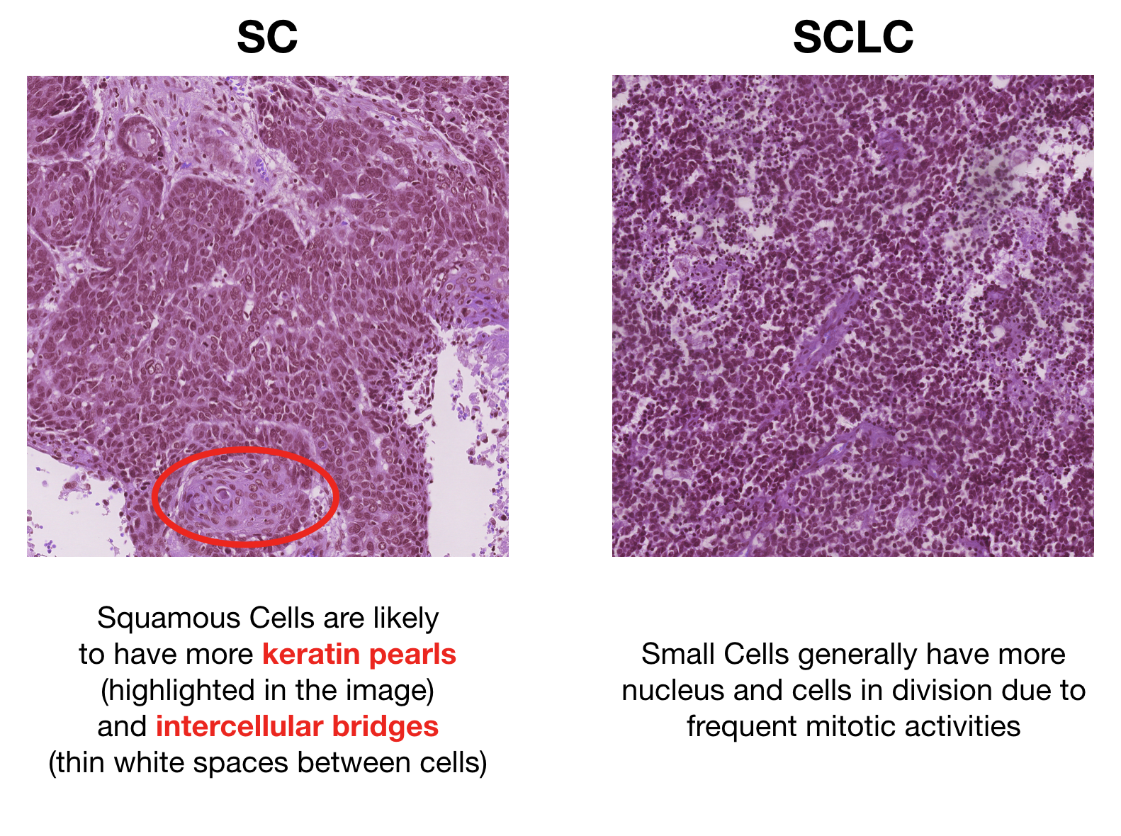 lung cancer histology classification Lung tumors classification jto