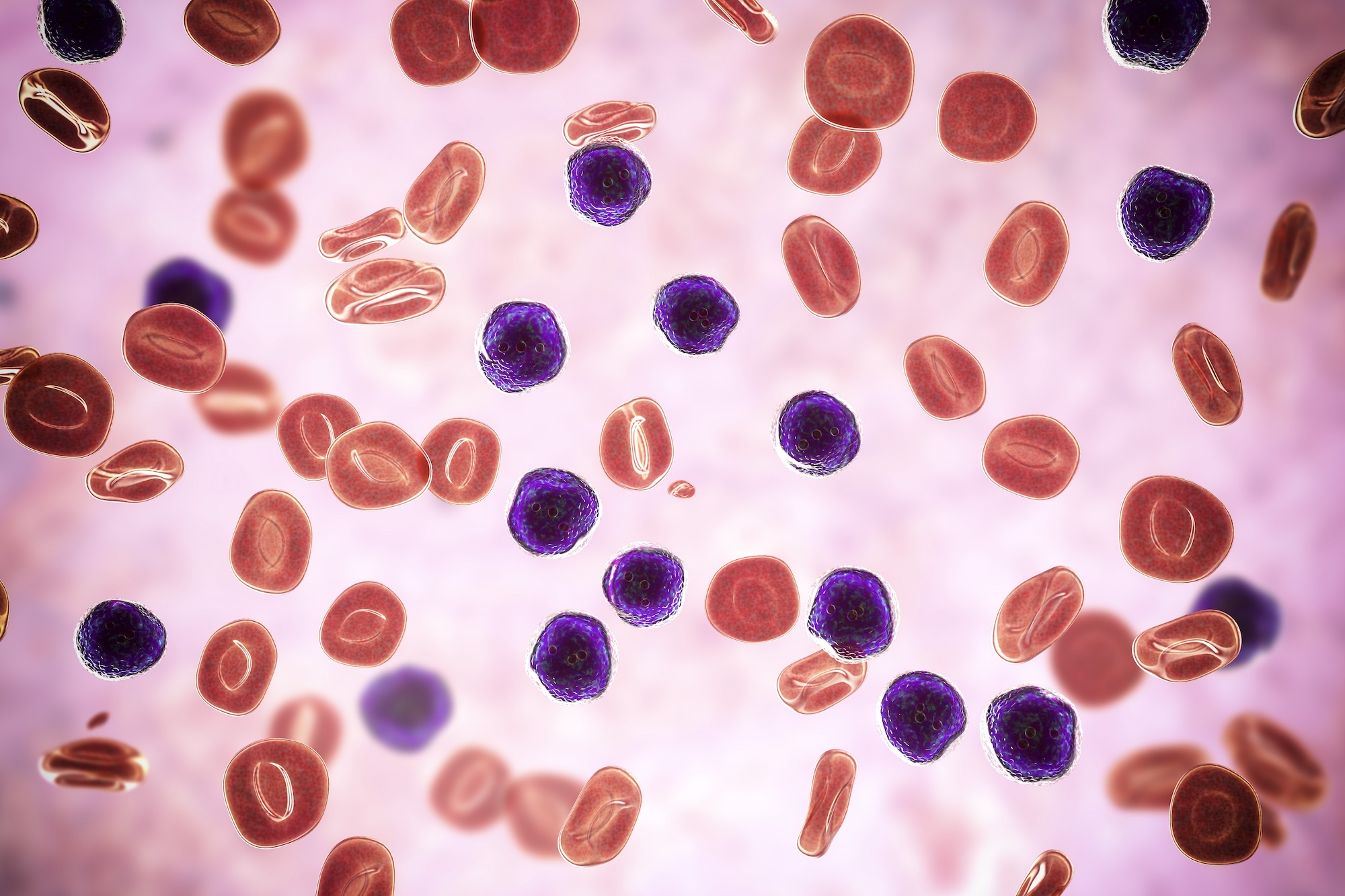 Acute lymphoblastic leukaemia, illustration