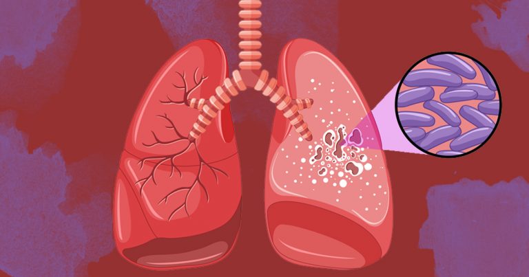 Fotomontagem que mostra pulmões contaminados pela bactéria causadora da tuberculose, que aparece em destaque na imagem.