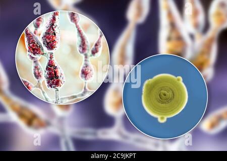 Filamentous allergenic fungus Alternaria alternata, computer illustration of fungal morphology and photograph of fungal colonies on Sabouraud Dextrose Stock Photo