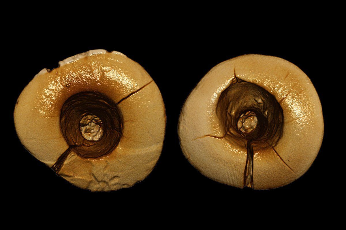 World's oldest dental fillings: Italy sets world record (VIDEO)