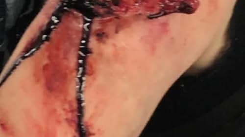 blood tubing under the wound