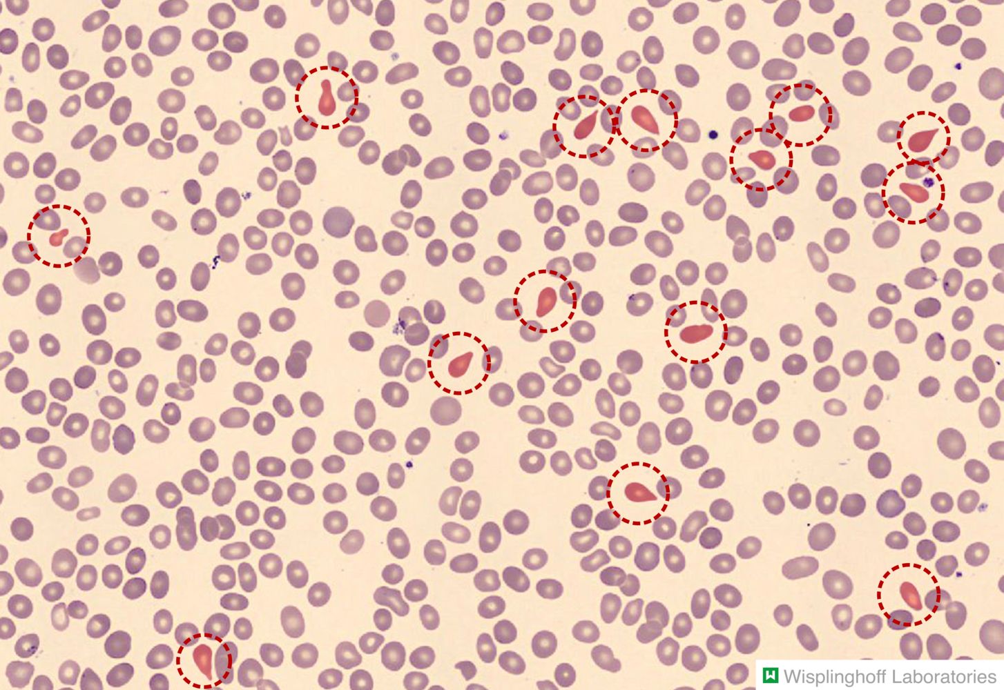 Beta Thalassemia Blood Smear