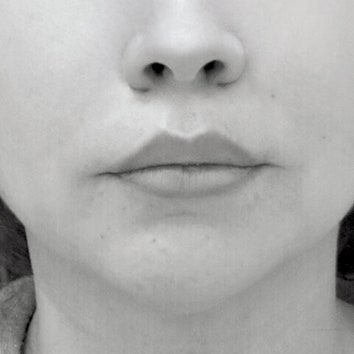 Meet the Lip Lift, the Permanent Alternative to Lip Filler