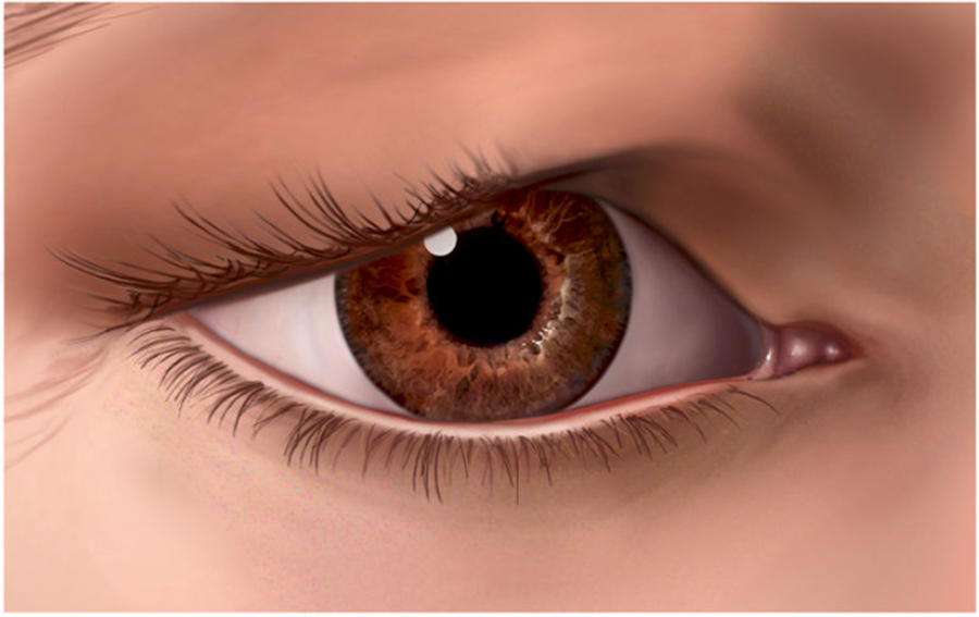 Illustration showing a sagging eyelid.