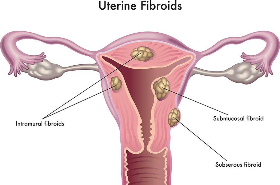 Illustration of uterine fibroids.