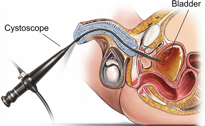 Illustration showing a flexible cystoscopy.