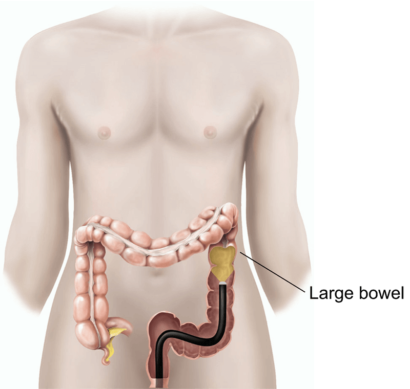 Illustration of a flexible sigmoidoscopy.