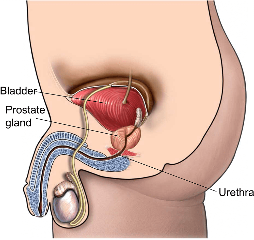 An illustration showing a stone in the ureter.