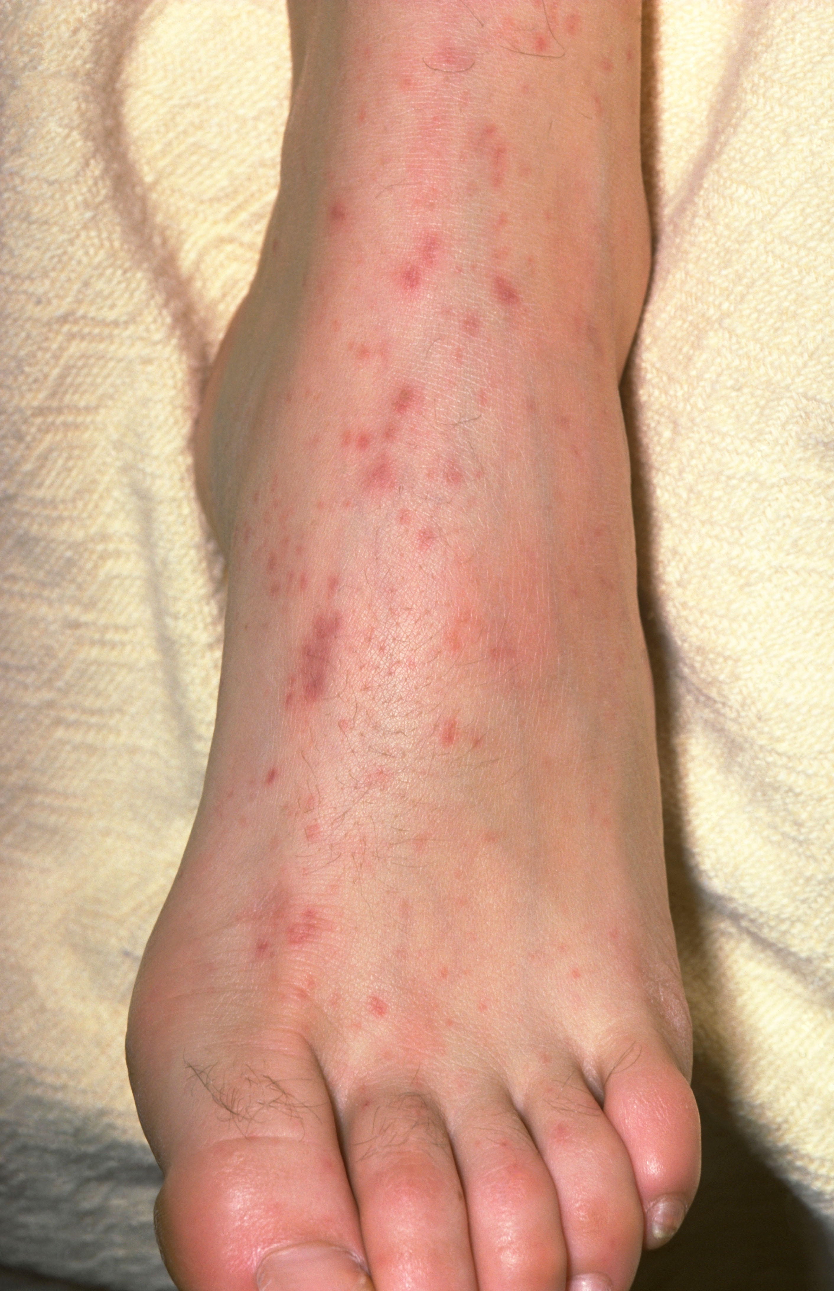 Photograph of a foot with meningococcal rash.