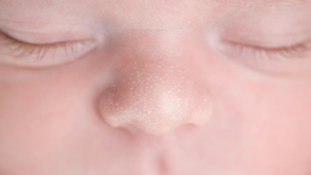 Image of Milia present on a babies nose