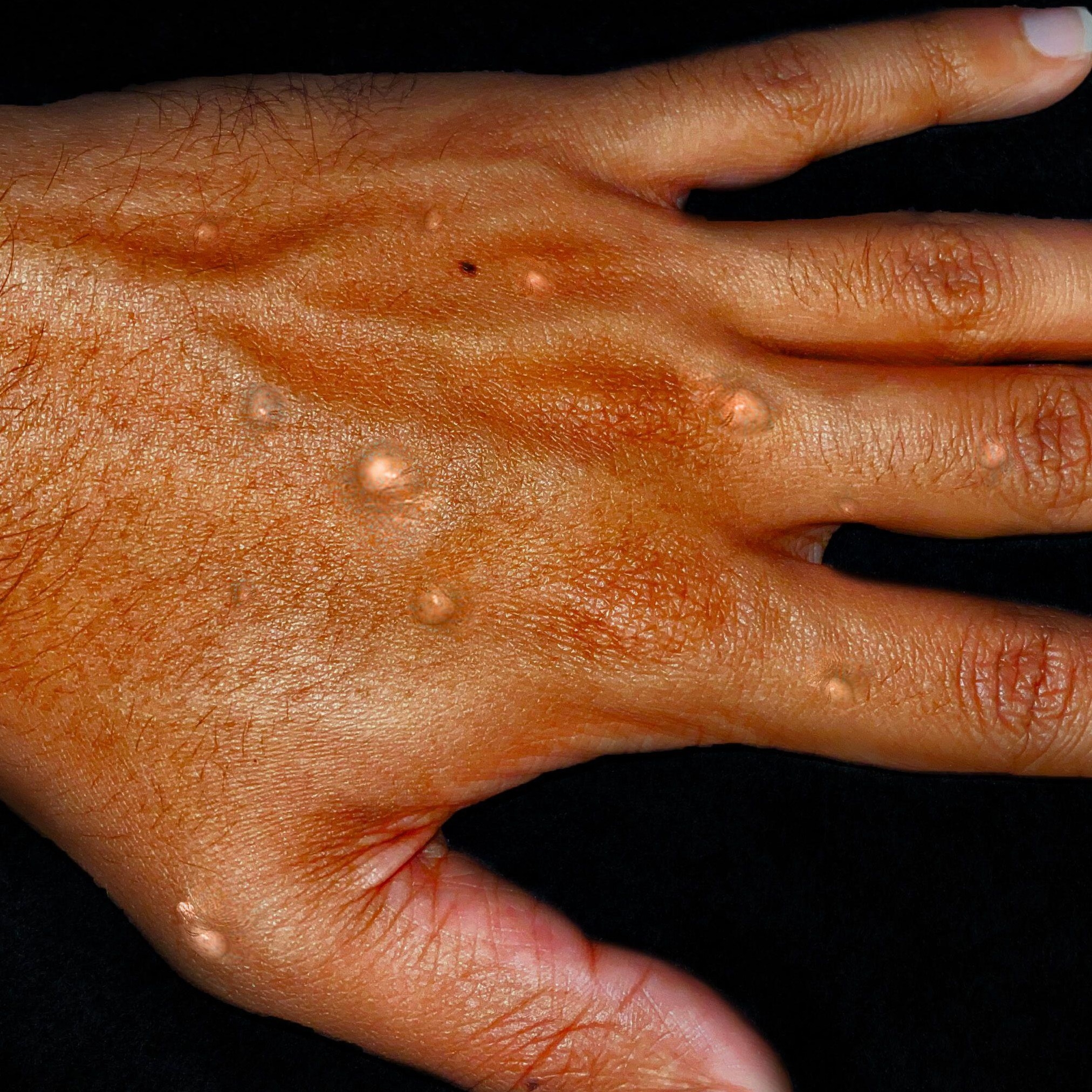 Monkeypox blisters on a hand