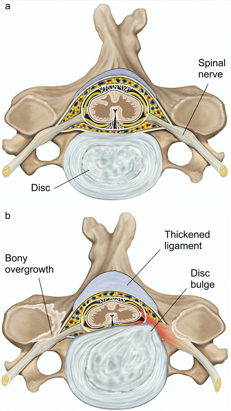 Illustration of a spinal canal and disc