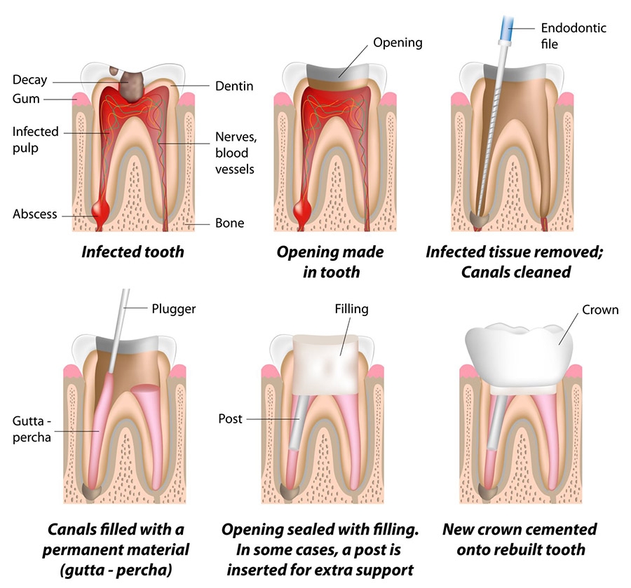 Illustration showing the steps involved in a root canal treatment.