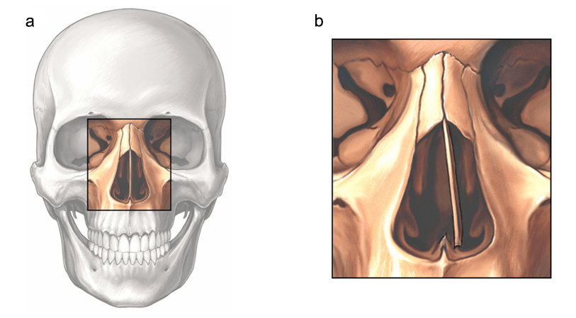 Illustration showing a comparison between a straight and bent nasal septum.