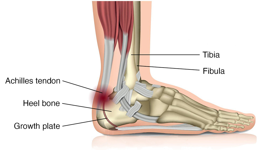 Illustration showing anatomy of a heel-pain.