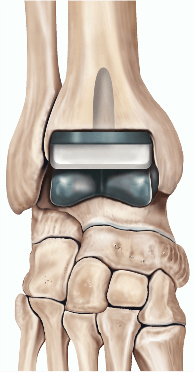 Illustration showing a total ankle replacement.