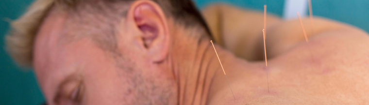 Image of man receiving acupuncture treatment on his back. 