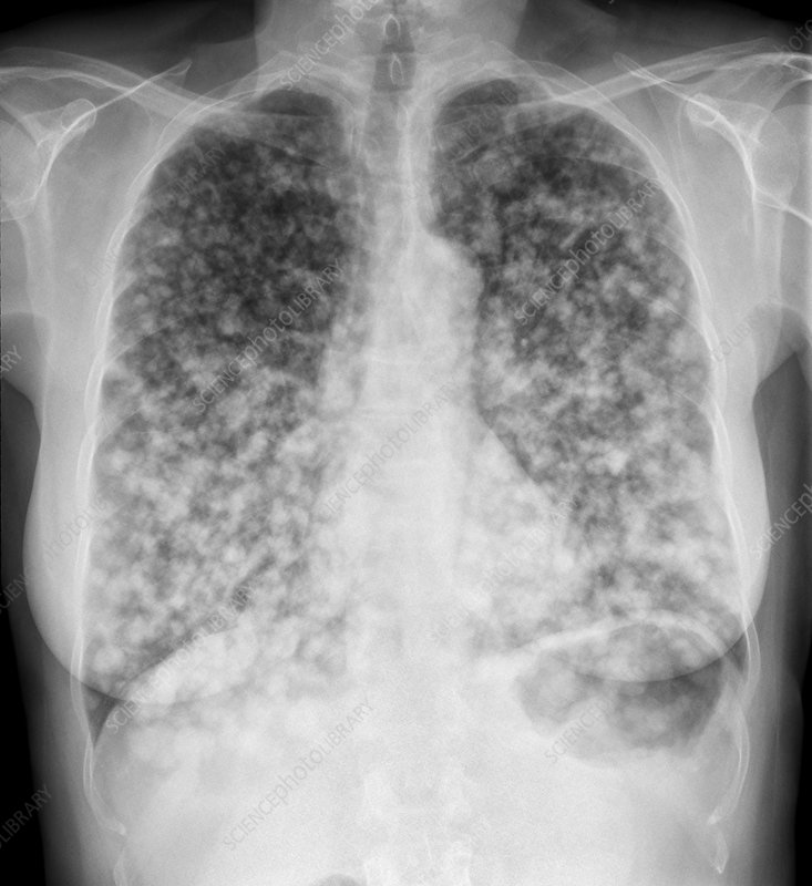 Lung Cancer Xray