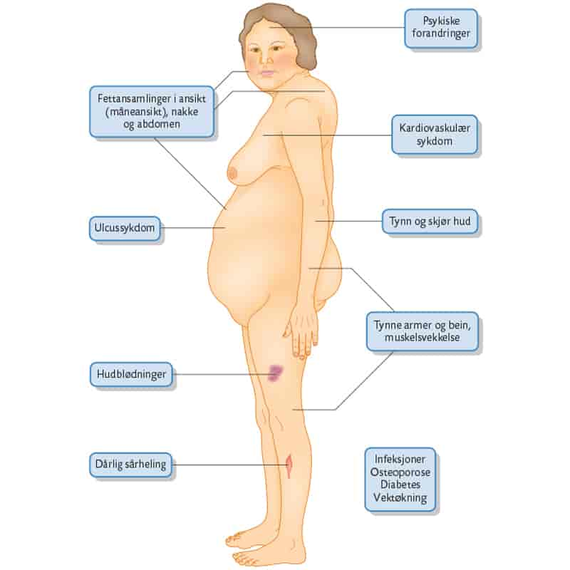 Illustrasjonen viser en dame med typiske symptomer og funn: psykiske forandringer, fettansamlinger i ansikt, nakke og magen. Kardiovaskulær sykdom. Ulcussykdom. Tynn og skjør hud. Tynne armer og bein, muskelsvekkelse. Hudblødninger. Dårlig sårheling. Infeksjoner, osteoporose, diabetes, vektøkning.