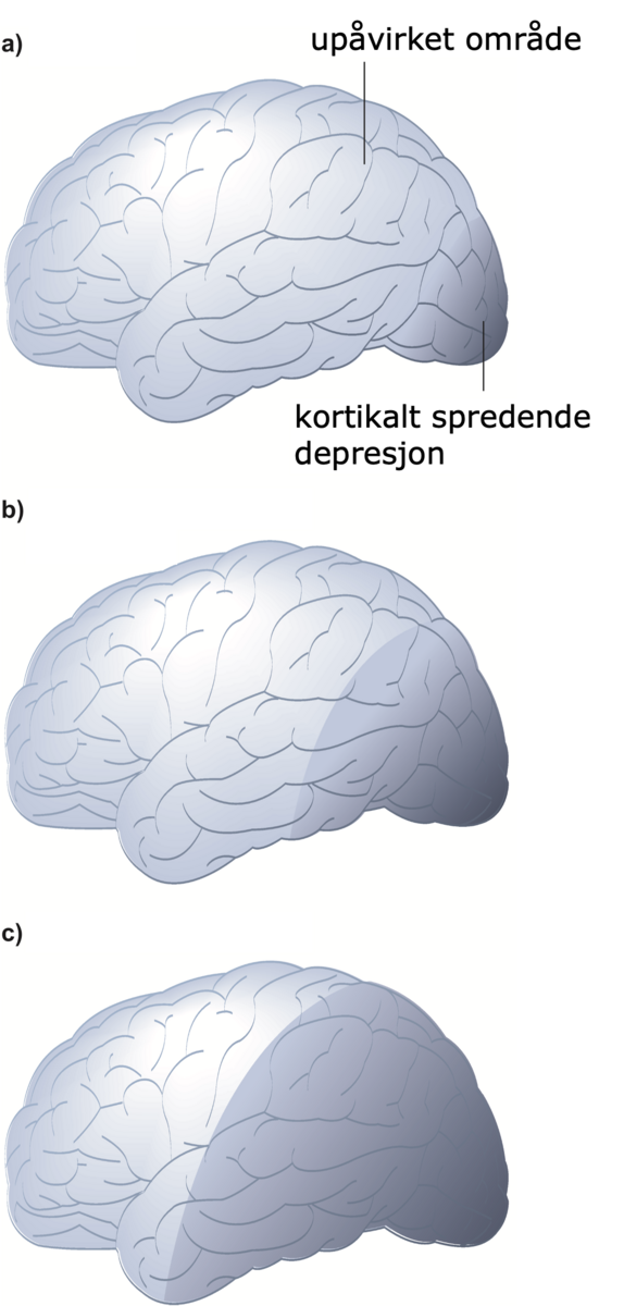 Kortikalt spredende depresjon