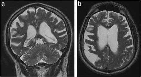 Alzheimers sykdom