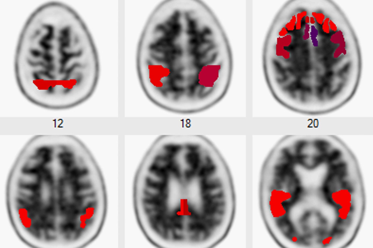 A New Blood Test May Predict Your Alzheimer’s Risk. Should You Take It?