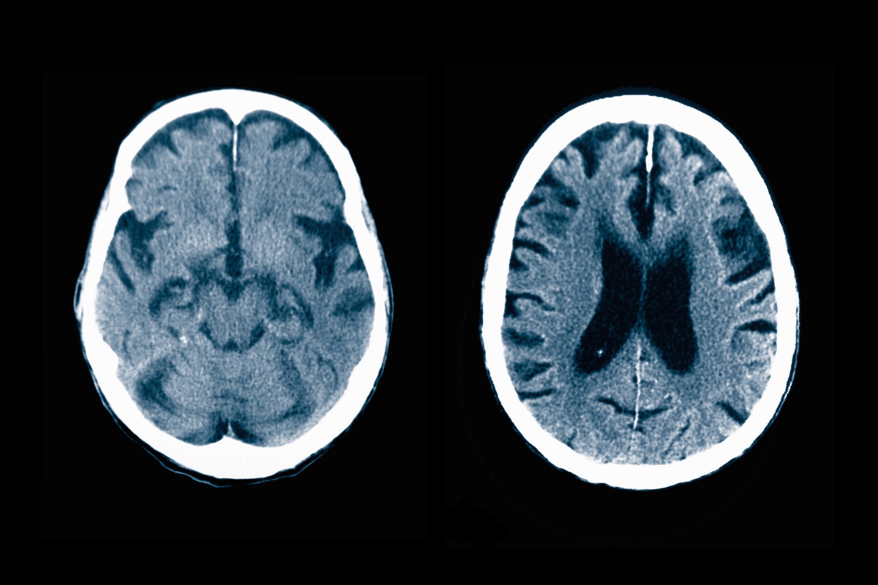 Nearly Everyone With Mild Cognitive Impairment Goes Undiagnosed