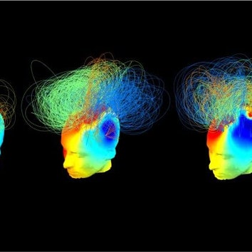 植物状態の人にも意識がある：脳波解析で明らかに