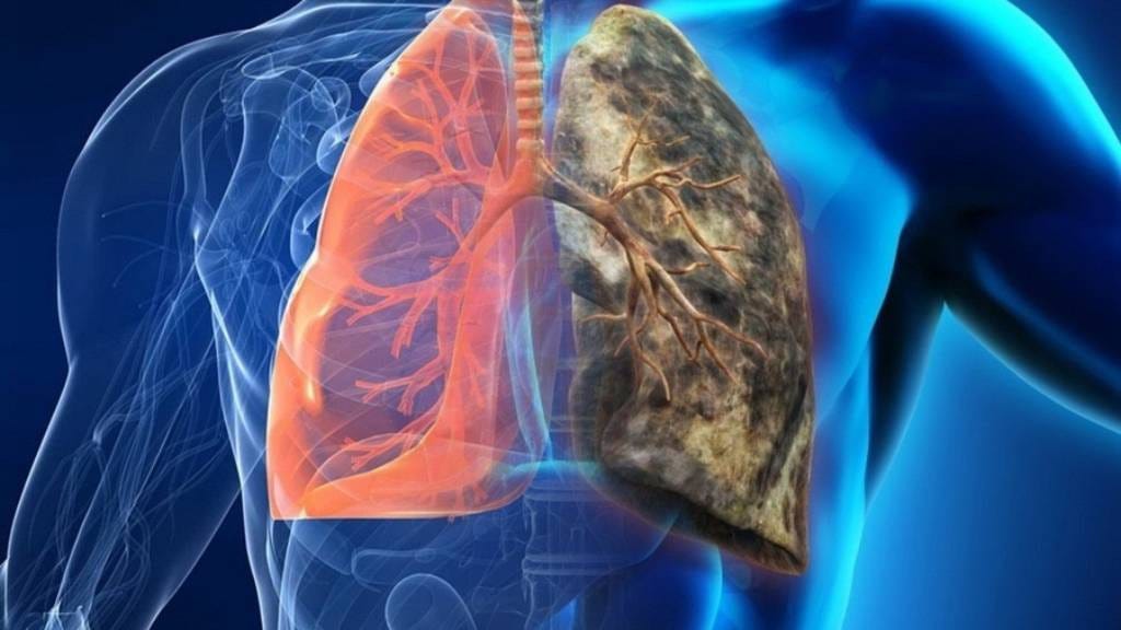 What is lung cancer? What are its main causes? | by Dr. Vijay Anand ...