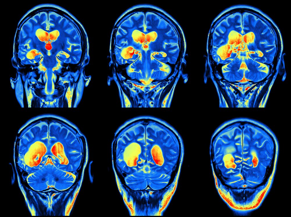 Ms Brain Mri With Contrast