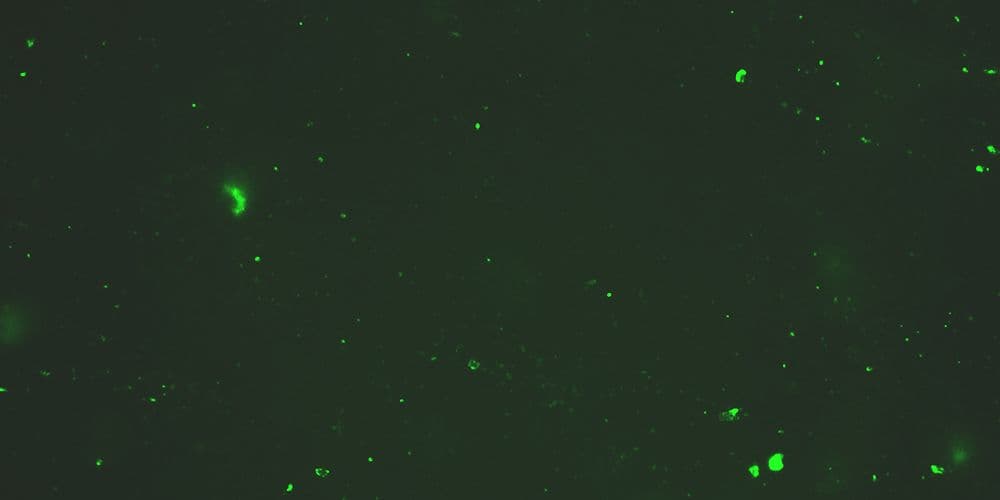 Pequenas quantidades de microcoágulos em fluorescente, de paciente sem covid longa