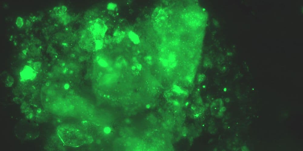 Grandes quantidades de microcoágulos marcados em fluorescente, em paciente com covid longa