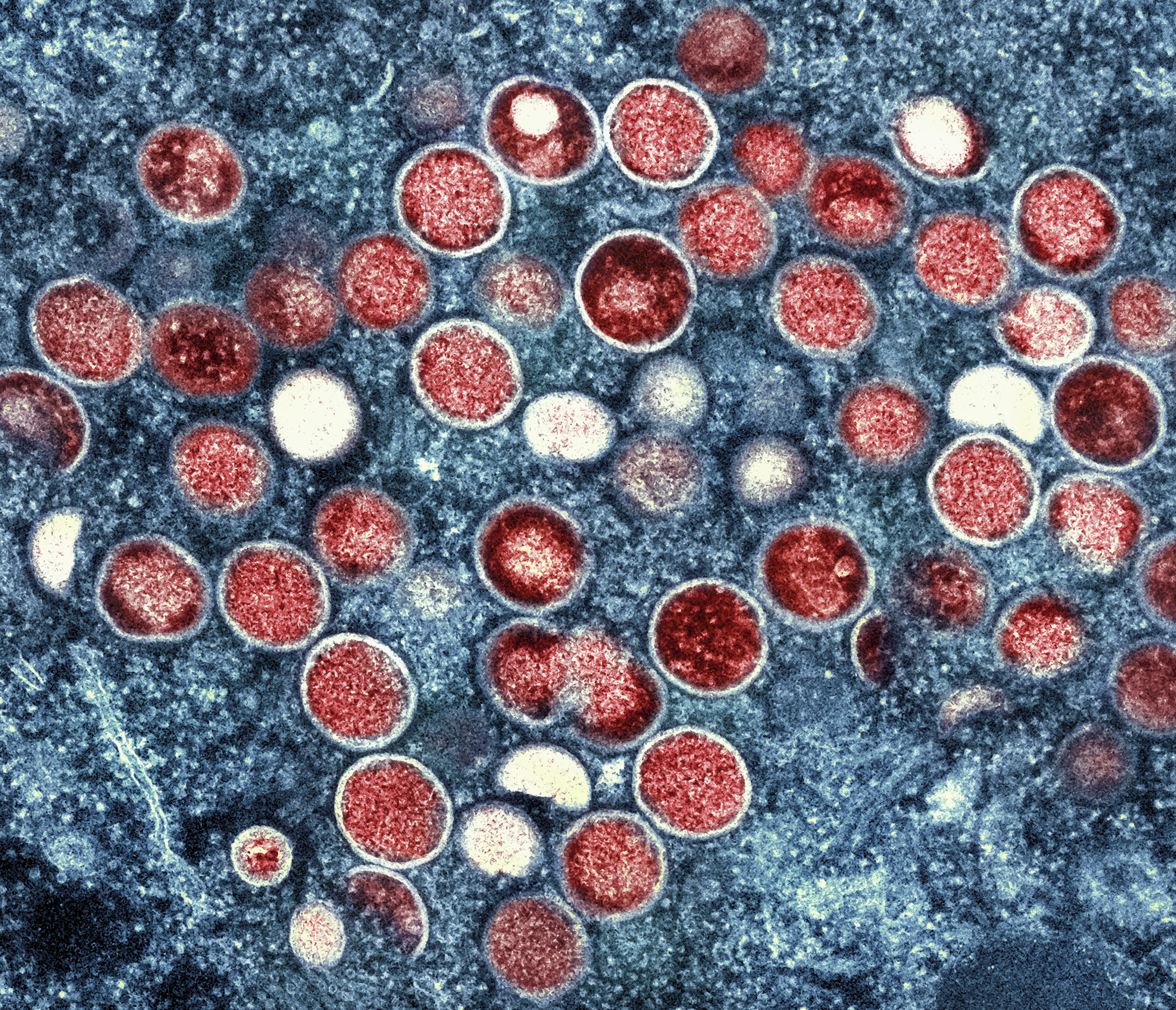 This image provided by the National Institute of Allergy and Infectious Diseases (NIAID) shows a colorized transmission electron micrograph of monkeypox particles (red) found within an infected cell (blue), cultured in the laboratory that was captured and color-enhanced at the NIAID Integrated Research Facility (IRF) in Fort Detrick, Md.