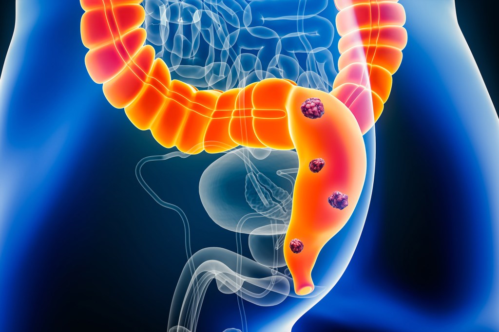 Colorectal cancer is one of the most common cancers worldwide — 1 in 24 Americans are estimated to develop it at some point.