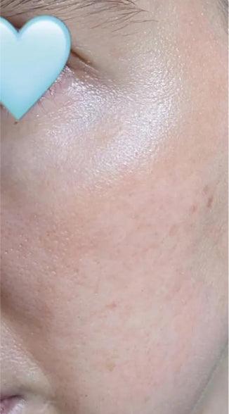 Reduced skin imperfections after using Omnilux mask