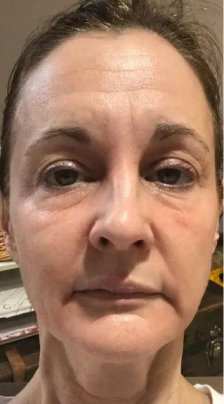 Face with wrinkles before using Omnilux mask