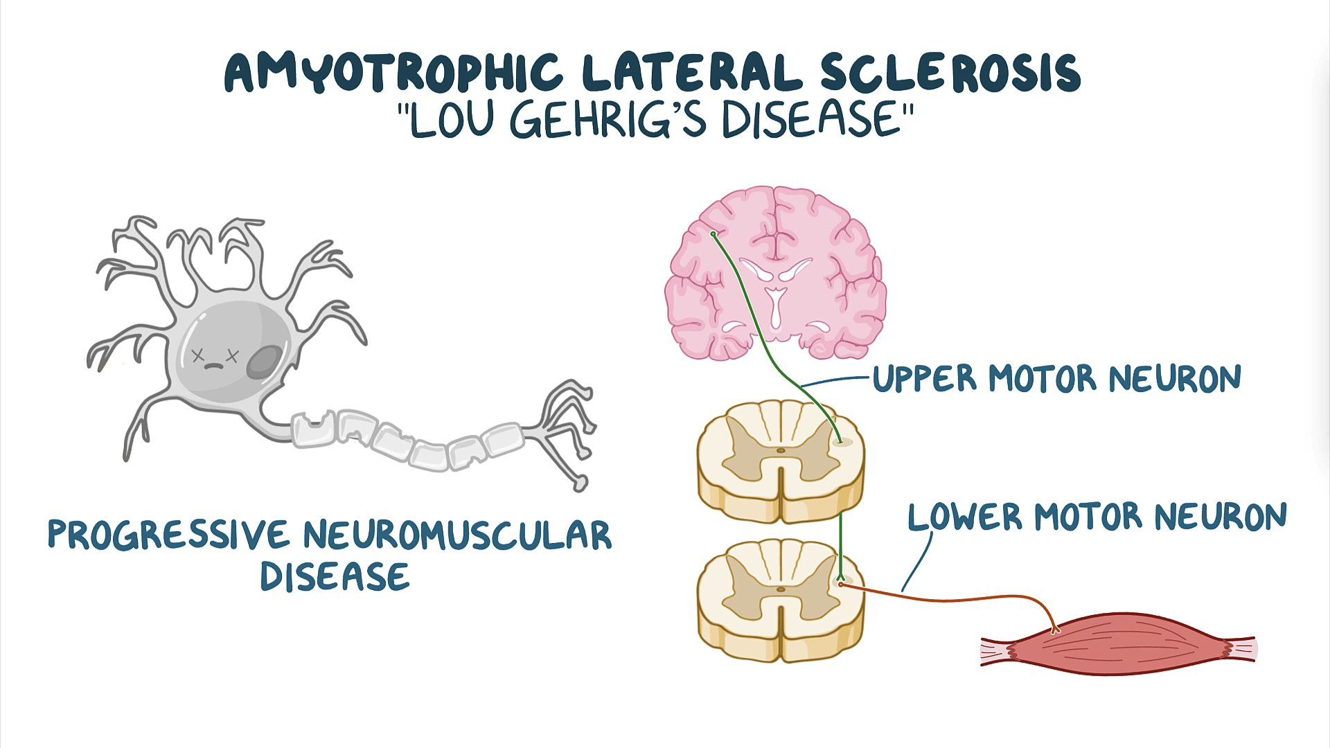 Amyotrophic Lateral Sclerosis Disease Reason