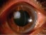 amniotic membrane as dressing for corneal perforation