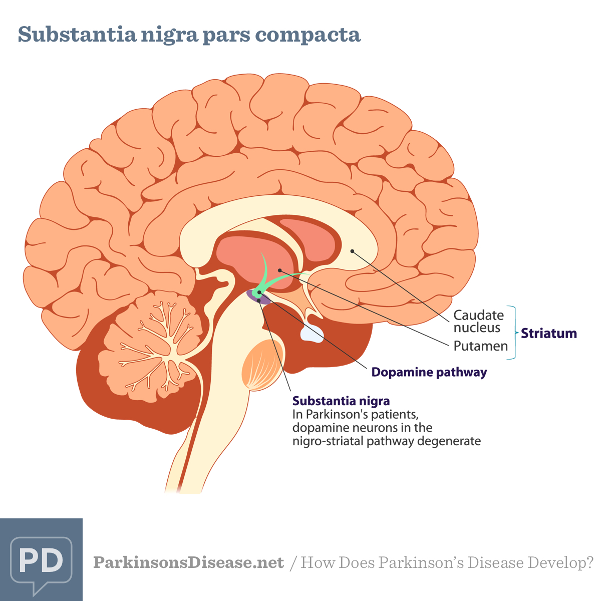 Parkinsons Disease Brain Diagram - minimalistisches Interieur