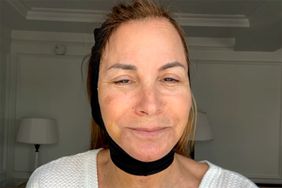 Jill Zarin facelift 