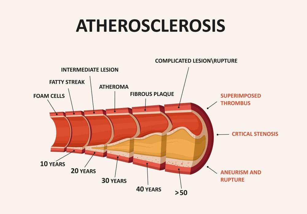 Atherosclerosis