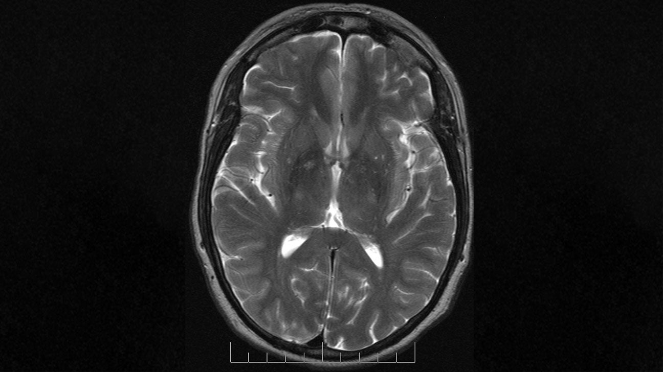 Mri Images Of The Brain