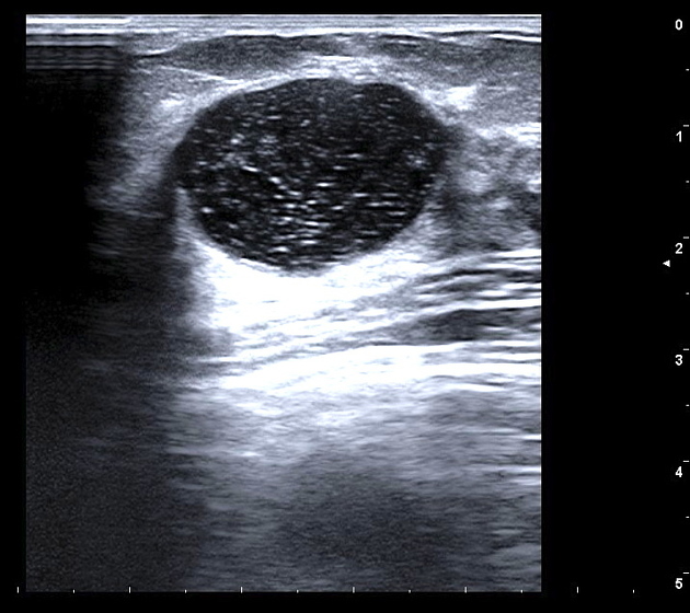 Acorn Cyst Breast Ultrasound Sale Online | mcpi.edu.ph