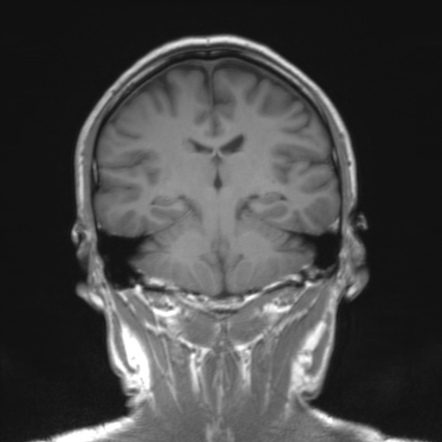 Healthy Brain MRI Scan