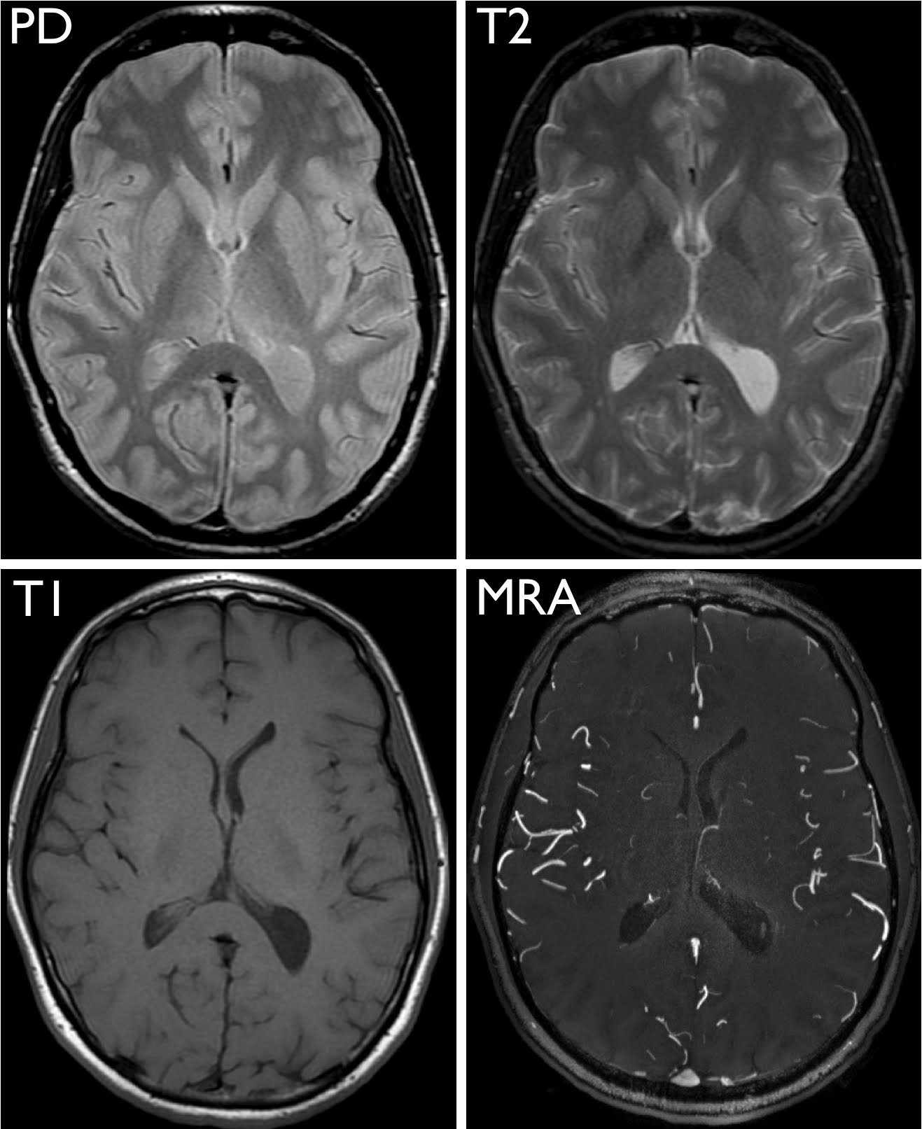 Normal Brain Mri With Contrast Images Radiologia